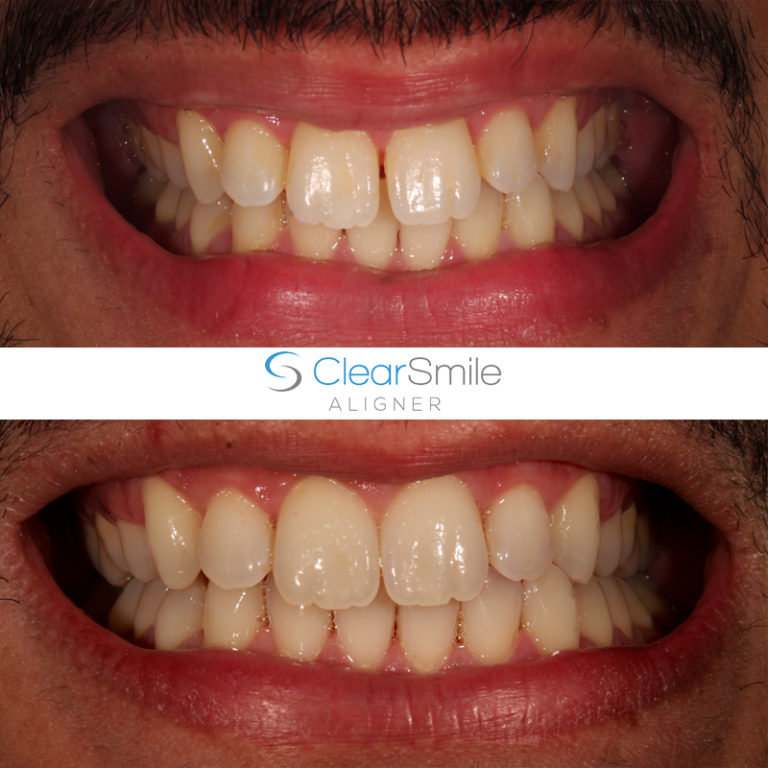 Clear Smile - ClearSmile